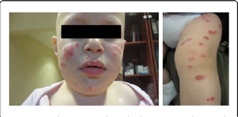 Figure 1 From Two Cases Of Pediatric Keratosis Lichenoides Chronica