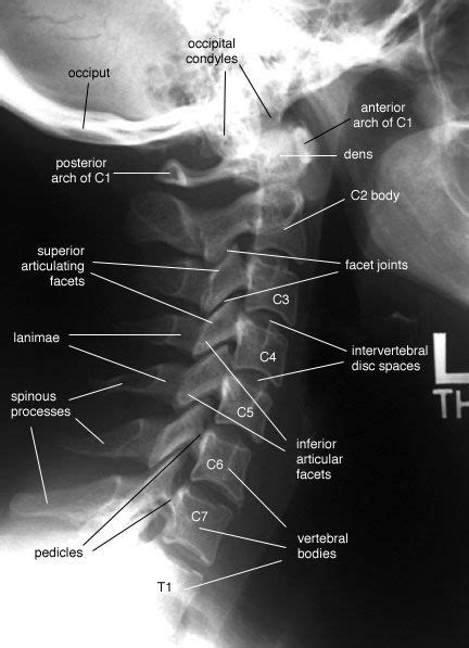 Lateral Cervical X Ray Leticiakruwlyons