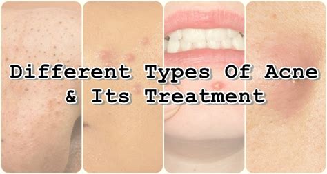 Acne Different Types Of This Face Condition And Its Treatment