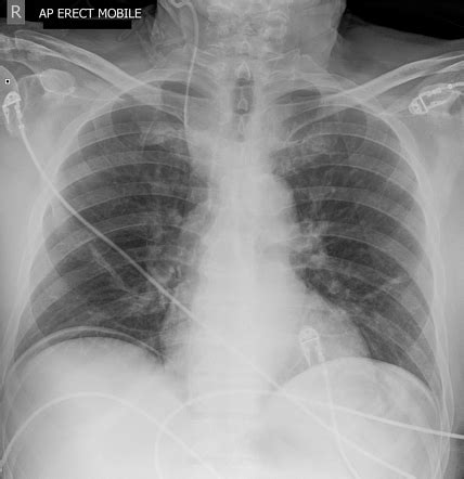 Malpositioned Internal Jugular Central Venous Catheter Radiology Case Radiopaedia Org