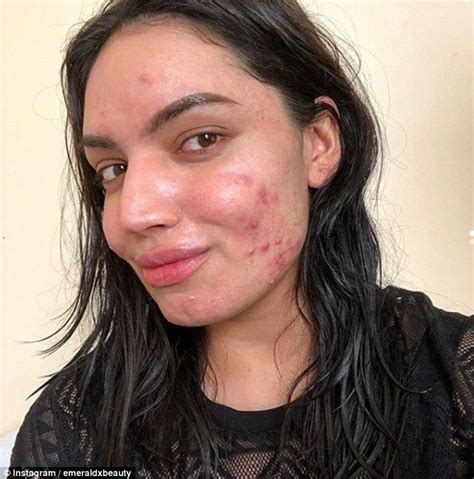Make Up Artist With Acne Shares Bare Faced Photos Pimples On Face