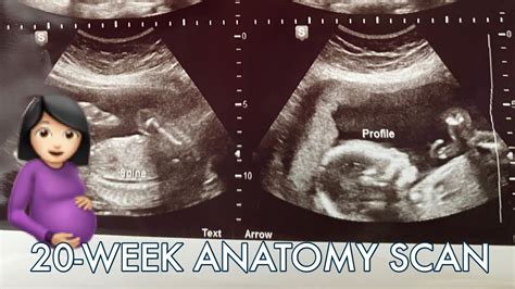 Anatomy Scan 20 Weeks Breech Baby Youtube