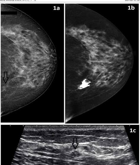 Figure From Ultrasonography Findings Of Breast Microcalcifications