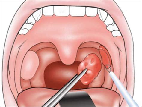 Tonsillectomy And Adenoidectomy Post Operative Care
