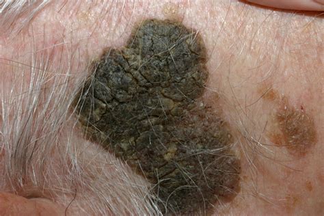 Home Remes For Seborrheic Keratosis Homemade Ftempo