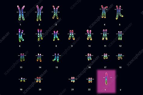 Turner S Syndrome Karyotype Female Stock Image C003 7182 Science