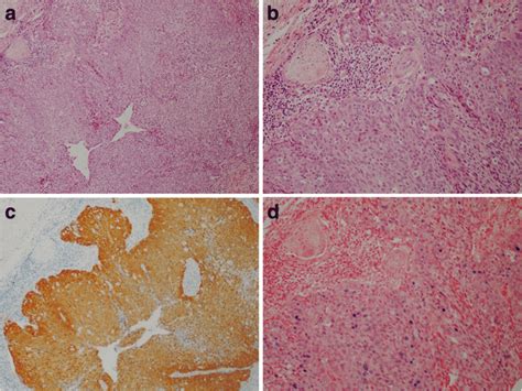 Hpv Related Oropharyngeal Squamous Cell Carcinoma A And B Hande Stain