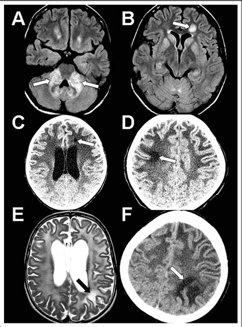 Figure 1 From Focal Central White Matter Lesions In Alexander Disease