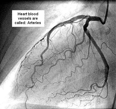 What Is A Coronary Angiogram