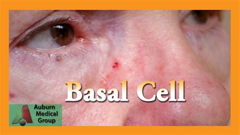 Basal Cell Carcinoma Punch Biopsy Auburn Medical Group Youtube