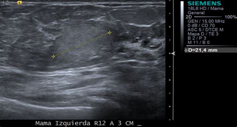 Bilateral Galactocele Eurorad