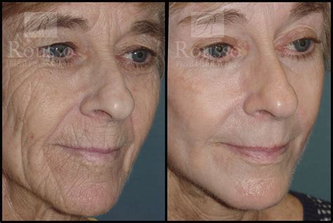Patient 2126625 Chemical Peel Before And After Rousso Facial Plastic