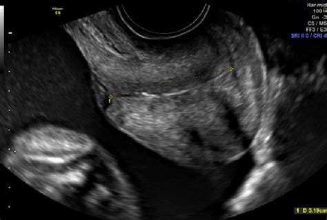 Transvaginal Ultrasound Examination Showing The Cervical Length Download Scientific Diagram