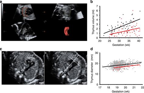 Impaired Fetal Thymic Development In Preeclampsia Anepean Cohort 1