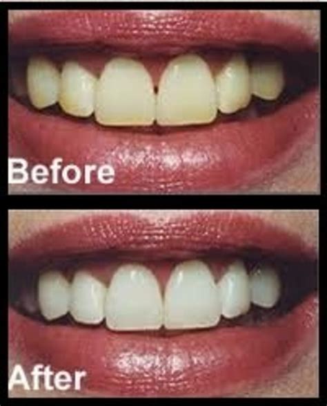 A combination of white vinegar and baking soda is an effective solution to remove plaque. Before and After: Homemade Teeth Whitening Recipe With ...