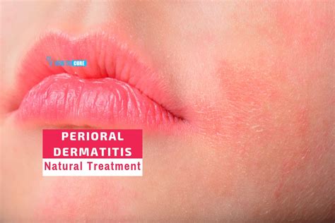 Perioral Dermatitis Nose Treatment Jcap
