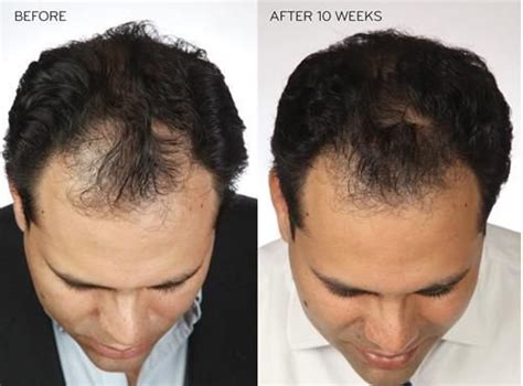 Top 100 Image How To Regrow Hair On Bald Spot Fast Vn