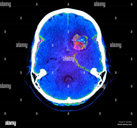 Subarachnoid Haemorrhage CT Scan Stock Photo Alamy