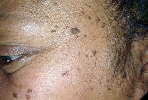 Pictures Of Skin Diseases And Problems Dermatosis Papulosa Nigra Dpn