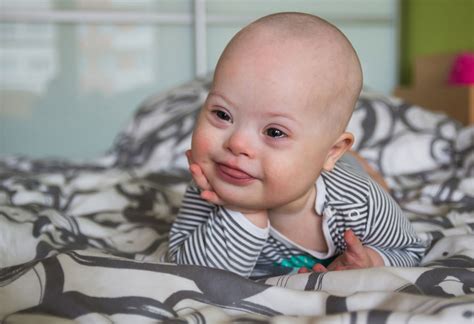 Down Syndrome In Babies Types Causes And Treatment