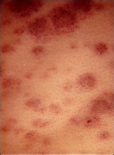 Estas manchas se dan sobre todo en el pecho y el cuello. Leucemia - el A. B. C de esta enfermedad - Taringa!