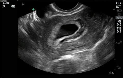 Subchorionic Hematoma Incidental Finding Or Early Risk — Everyday Ebm