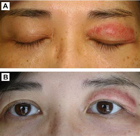 Figure 1 From Cutaneous Lupus Erythematosus Manifesting As Unilateral