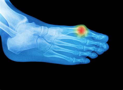 Risks Of Having Bunion Surgery