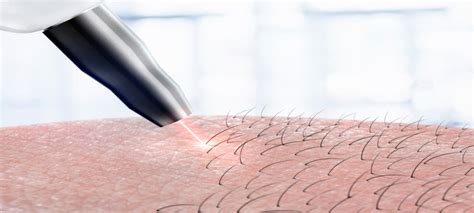 Laser Hair Removal Benefits Costs And Side Effects Solea Medical Spa