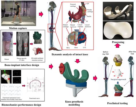 Workflow And Processing Of Patient‐specific Knee Prosthesis Design With