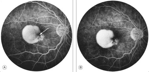 Neovascular Exudative Or Wet Age Related Macular Degeneration