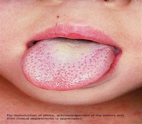 Strep Infection Tongue Images And Pictures Becuo