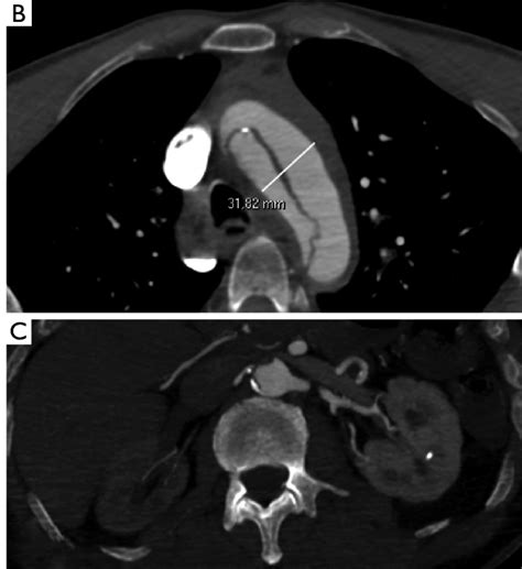 Angio Ct Of Patients With A Type A Aortic Dissection Presenting With