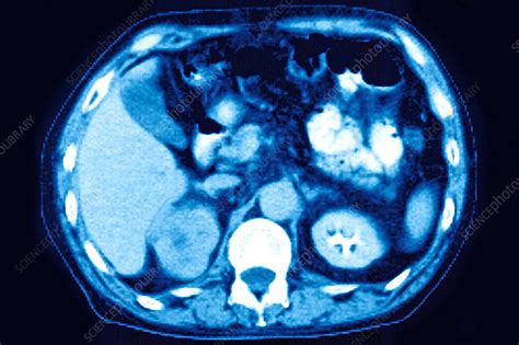 Kidney Cancer Ct Scan Stock Image C0297696 Science Photo Library