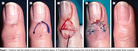 Figure 2 From Skin Excision And Osteophyte Removal Is Not Required In