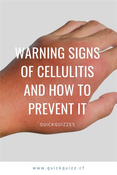 Warning Signs Of Cellulitis And How To Prevent It Skin Diseases