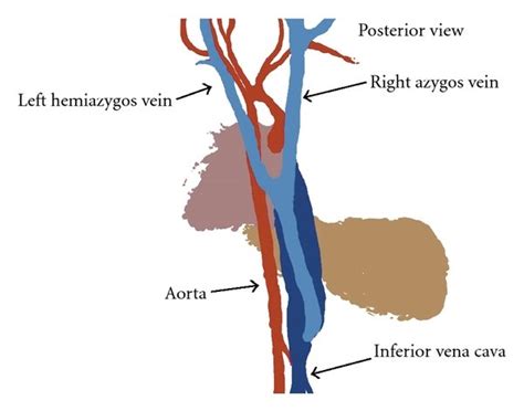 A Schematic Drawing Of Azygos Vein And Hemiazygos Vein Fusion In The