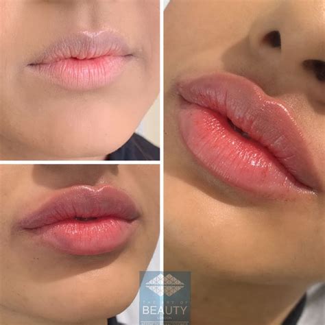 lip facial fillers and botox on instagram “russian lip tenting technique using 1ml juvederm