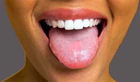 Tongue Diseases Smile Centre India