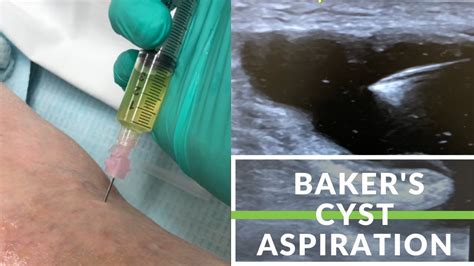 Simple Baker S Cyst Aspiration Youtube