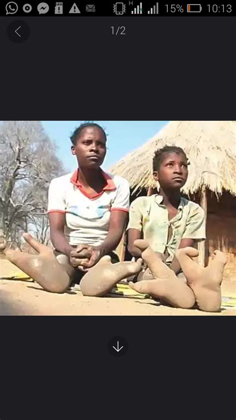 Zimbabwes Special People With Two Toes Wassap 9ja Breaking News