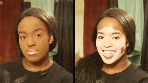 Vitiligo Makeup Before And After Saubhaya Makeup
