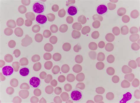 Disorders Of Leukocyteswhite Blood Cells An Overview Interactive