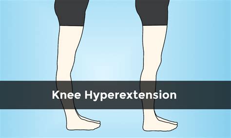 Treating A Hyperextended Knee Dr Kamkar Medical Physiotherapy Center