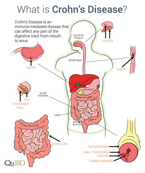 Crohn S Disease Ibd Symptoms Advances Impact Causes