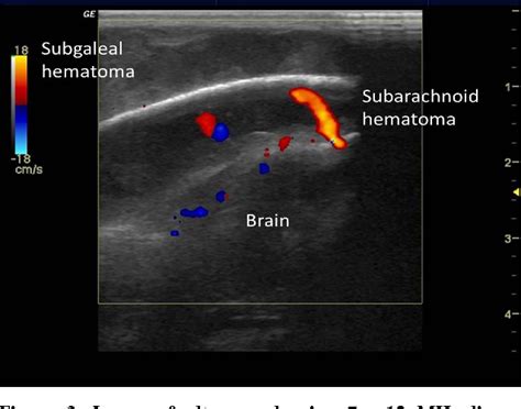 Subarachnoid Space Hemorrhage Ultrasound