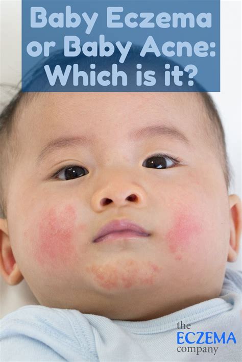 How To Tell The Difference Between Eczema And Baby Acne Glenn Scruggs