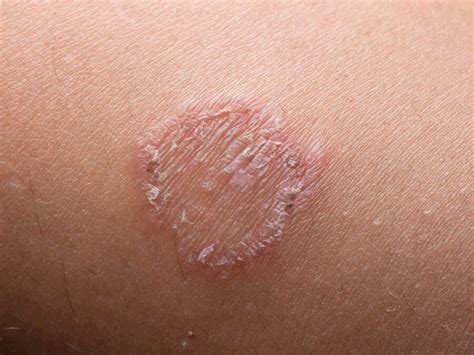 3 Symptoms That May Indicate A Ringworm Treating Fungus