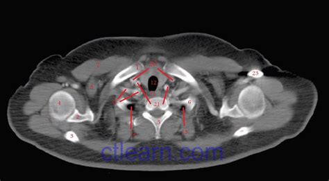 Learn Ct Scan Anatomy Ct Axial Chest