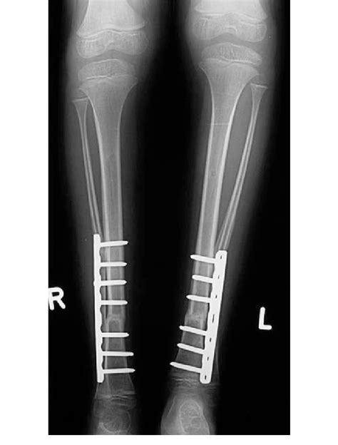 Patient No 3 10 Weeks After Tibial Derotation Osteotomies Showing